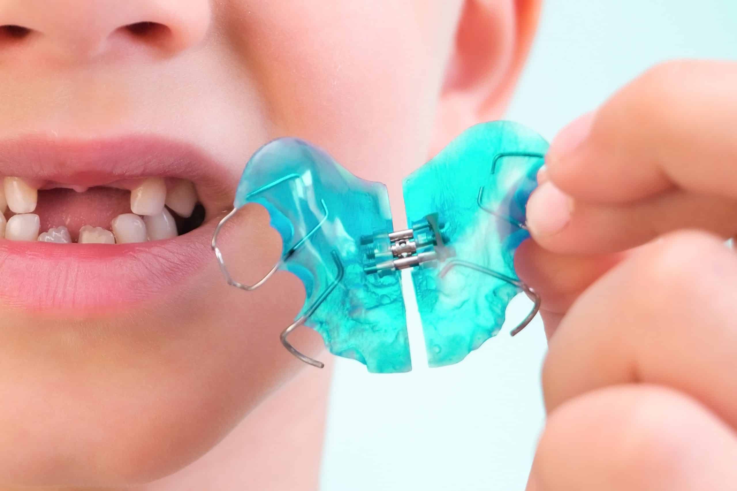 dental-plate-expansion-jaw-child-plate-heaven-there-is-enough-room-molars-happy-boy-holding-orthodontic-plate-his-hands-1-scaled