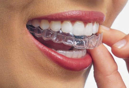 img-Invisalign-especialista-certificado